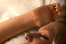 Selvskader, ”Cutter”. Ung sovende pige har ar på armene efter at have skåret sig med en skarp genstand. Modelfoto