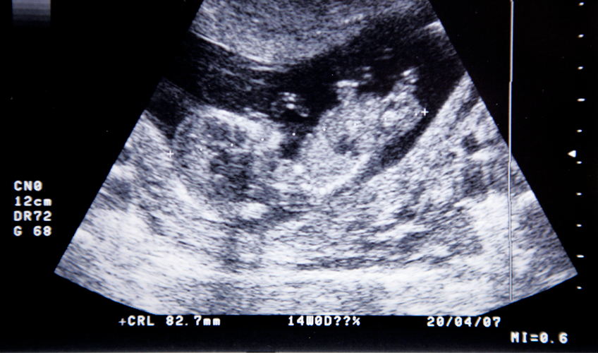 Billede af en ultralydsscanning som viser et femten uger gammelt foster